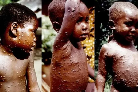 What is Monkeypox Virus? Symptoms, Diagnosis and Everything You Need to Know 15 maymun cicegi virusu2.webp