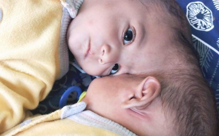 Pakistani Conjoined Twins Separated in a Successful 14-Hour Surgery in Turkey! 139 Pakistanli Yapisik Ikizler Turkiyede Basarili Bir Operasyonla Ayrildi 1024x576