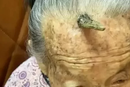 A 107-Year-Old Man Grew Horns on His Head! What is Horn Disease and Why Does It Occur? 73 Kafasinda Boynuz Cikan 107 Yasindaki Kadin Dunya Gundeminde1 1024x576.webp