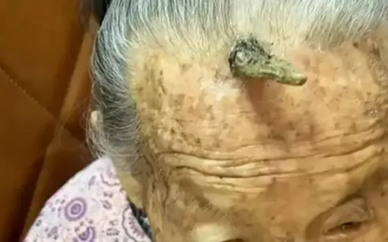A 107-Year-Old Man Grew Horns on His Head! What is Horn Disease and Why Does It Occur? 37 Kafasinda Boynuz Cikan 107 Yasindaki Kadin Dunya Gundeminde1 1024x576.webp